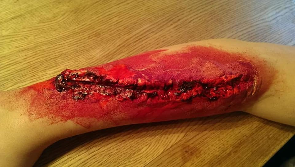 Verletzungen RUD Arm Wunde